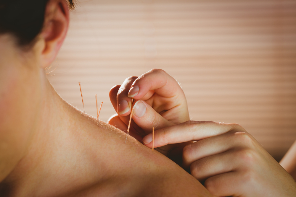 What is Acupuncture & What Can it Treat?