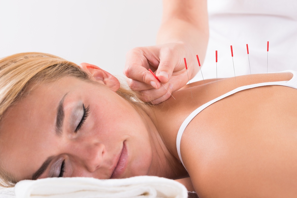 4 Benefits of Acupuncture